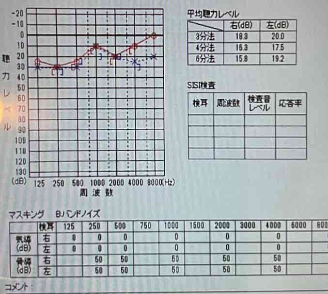 大阪市住吉区長崎はりきゅう接骨院の突発性難聴のオージオグラフ