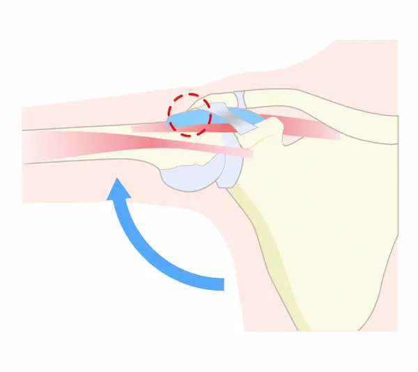 肩のインピンジメント症候群