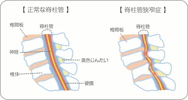 脊柱管狭窄症の画像