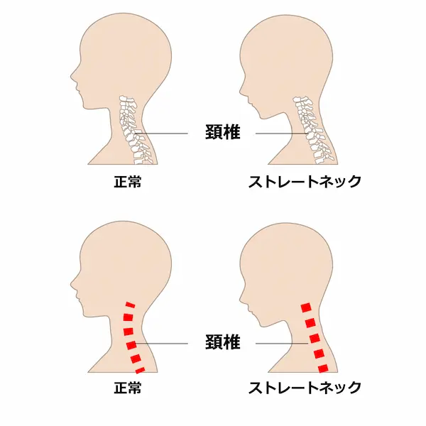 ストレートネックの画像