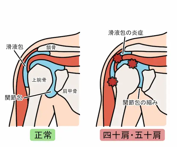 肩関節周囲炎の痛み